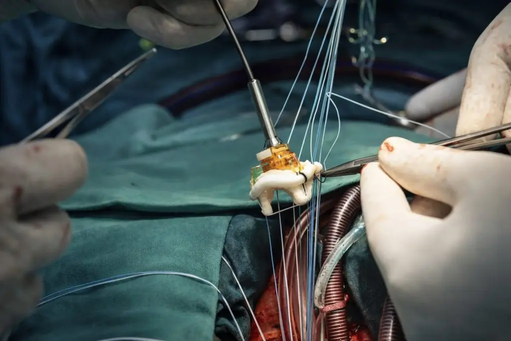 FTC blocks Edwards’ JenaValve deal — what EW stock investors watch next week